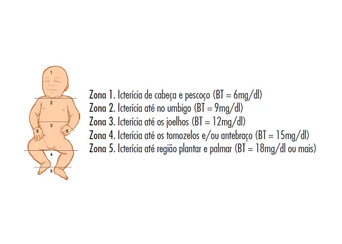 icterícia neonatal, As zonas de Kramer representam uma escala visual utilizada para avaliar a extensão da icterícia em recém-nascidos, com base na distribuição do tom amarelado na pele. Criada pelo pediatra Howard Kramer, essa ferramenta divide o corpo em cinco regiões anatômicas, que correspondem a diferentes níveis de concentração de bilirrubina no sangue. A icterícia neonatal ocorre devido ao acúmulo de bilirrubina, um pigmento resultante da degradação das hemácias. , bilirrubina, triagem neonatal, em, Técnicas enfermagem 